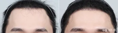 Before & After
