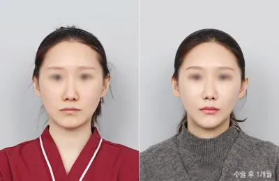 Before & After