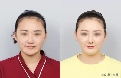 Before & After