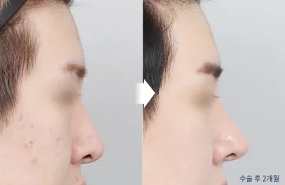 Before & After