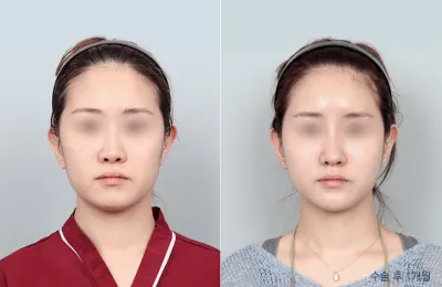 Before & After