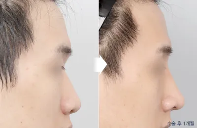 Before & After