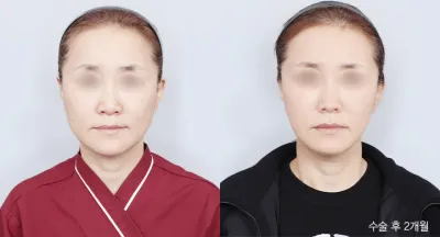 Before & After