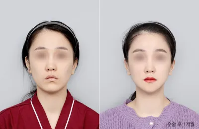 Before & After