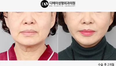 Before & After