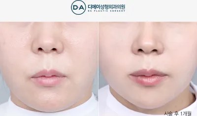 Before & After