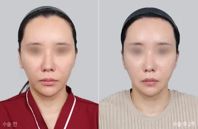 Before & After