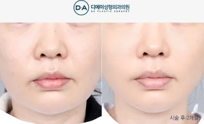 Before & After