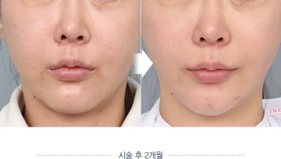 Before & After