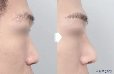 Before & After