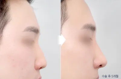 Before & After