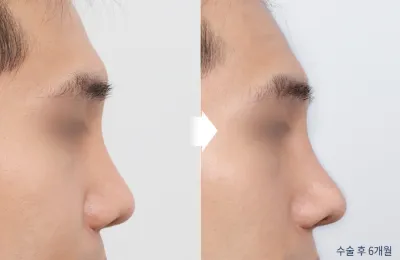 Before & After