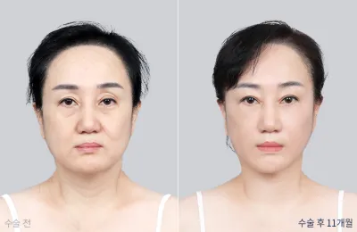 Before & After