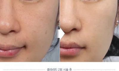 Before & After