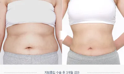Before & After