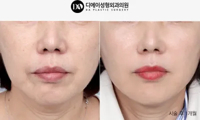 Before & After