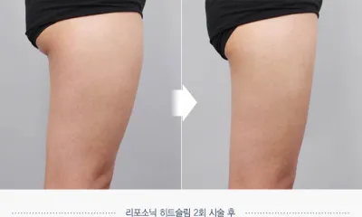 Before & After