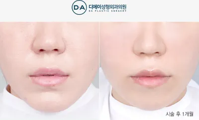 Before & After
