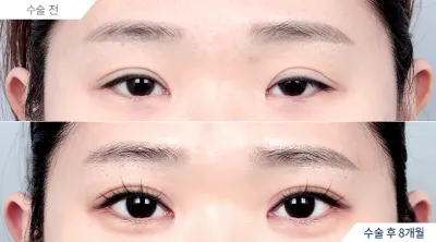 Before & After
