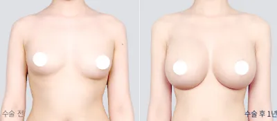 Before & After