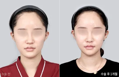 Before & After