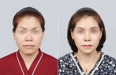 Before & After