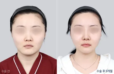 Before & After