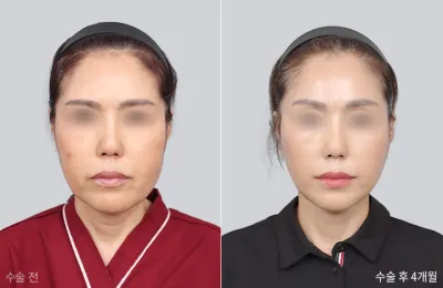 Before & After