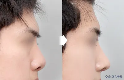 Before & After