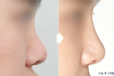 Before & After