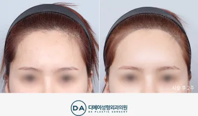 Before & After