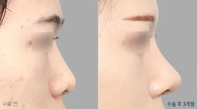 Before & After
