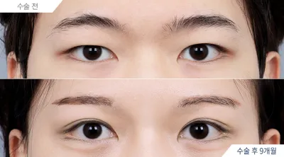 Before & After