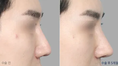 Before & After