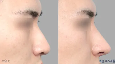 Before & After