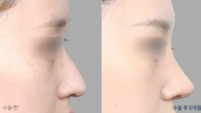 Before & After