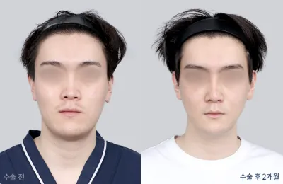 Before & After