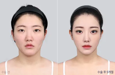 Before & After