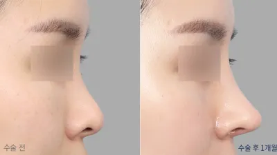 Before & After