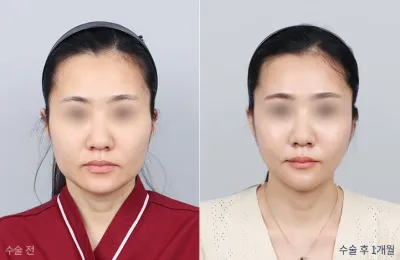 Before & After