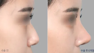 Before & After