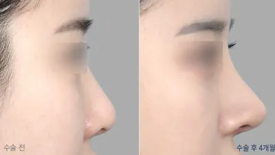 Before & After