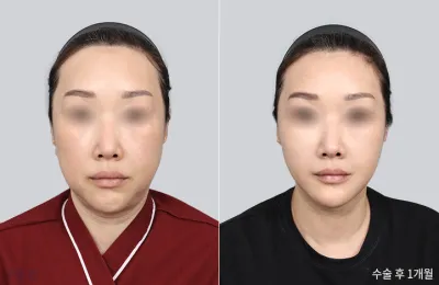 Before & After