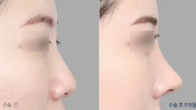 Before & After