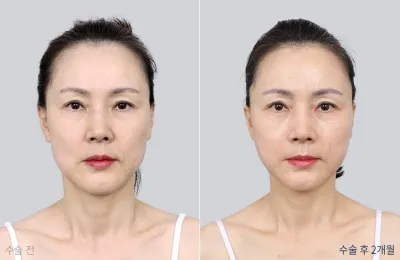 Before & After