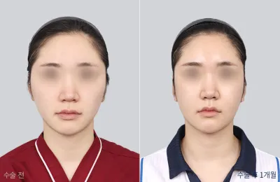 Before & After
