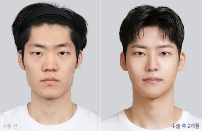 Before & After
