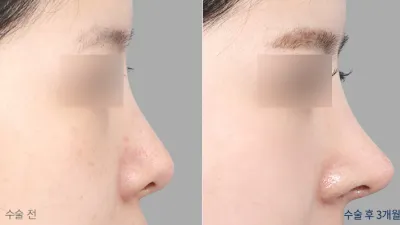 Before & After