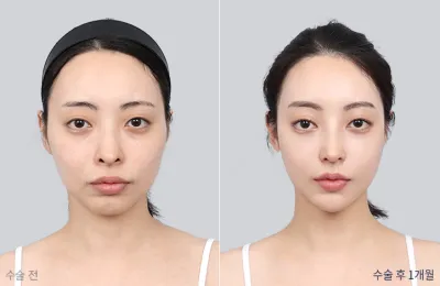 Before & After
