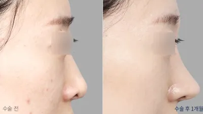 Before & After